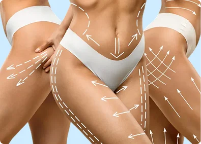 Referencia de abdominoplastia